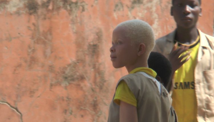 persecuzione albini africani